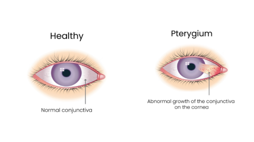 Dry-eye-syndrome-in-Brisbane.png