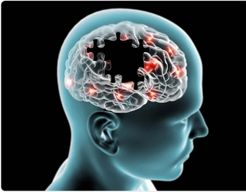 alzhemier.png