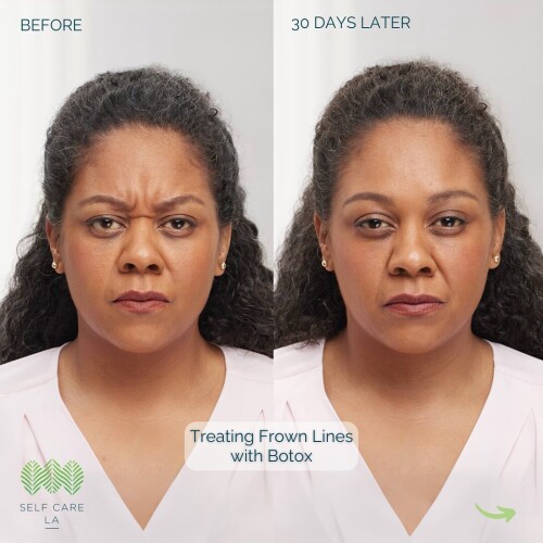 Microneedling-Santa-Monica-CA.jpg