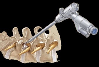 Spine-Endoscopy-in-Indore.jpg
